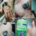 Review Diệp Lục Th Health Hỗ Trợ Vết Thương Hở