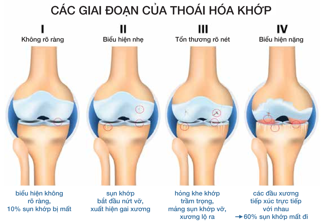 Các Giai đoạn Của Thoái Hóa Khớp